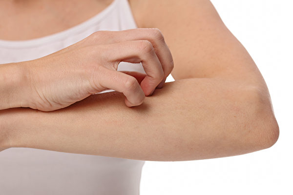荨麻疹发作时有何症状，如何正确止痒、治疗和保养？(Shutterstock)