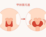 壓力大易致「甲狀腺亢進」二症狀要當心