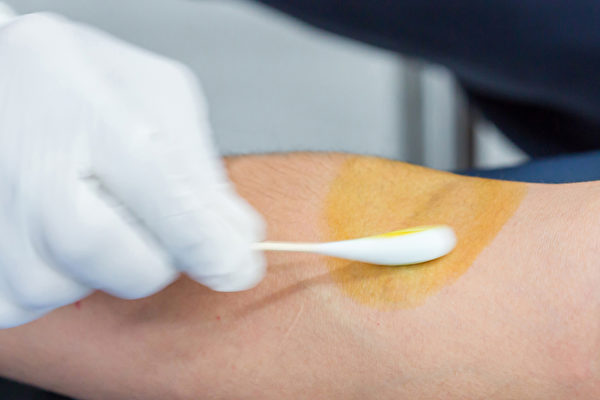 受傷時傷口上塗優碘，反而影響癒合。如何正確照護傷口？(Shutterstock)