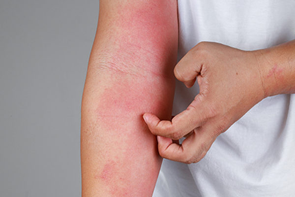 中醫師崔容瑄認為，異位性皮膚炎是體內的熱毒積聚所引起，5種方法可改善。(Shutterstock)