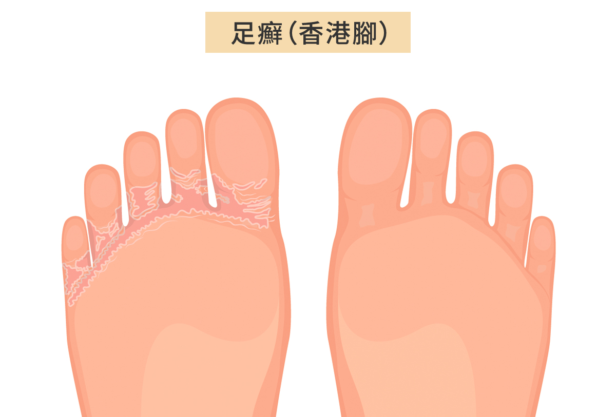 脚有症状别轻忽 常见足部疾病1篇看懂 香港脚 糖尿病足 嵌甲 大纪元