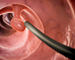 做大腸鏡能預防腸癌嗎?關於大腸鏡的10問