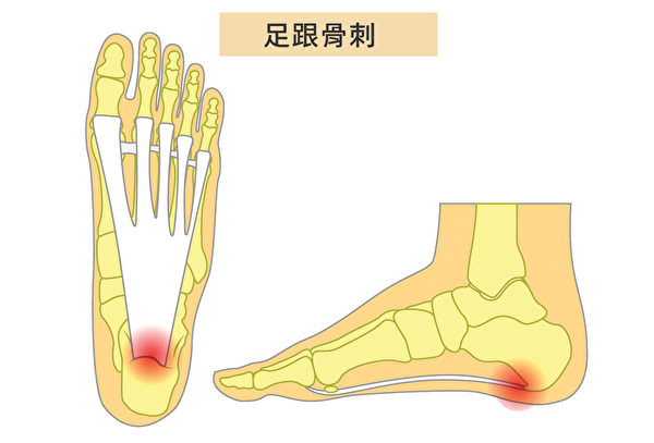 當足跟和足弓之間有鈣沉積物生長，即發生足跟骨刺（Heel Spurs），會引起腳跟劇痛。（Shutterstock/大紀元製圖）