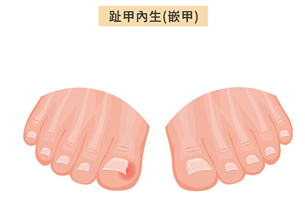 當腳趾甲開始長入兩側的趾甲槽時，即趾甲內生，或稱為嵌甲（Ingrown Toenails）。（Shutterstock/大紀元製圖）