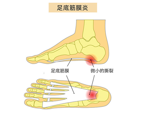 足底筋膜炎（Plantar Fasciitis）是足底筋膜發生炎症，症狀是腳後跟疼痛。（Shutterstock/大紀元製圖）