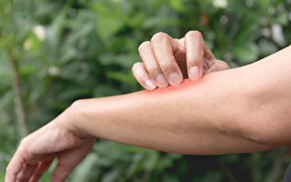 由蚊子传播的屈公病具体会引起哪些症状、如何预防？(Shutterstock)