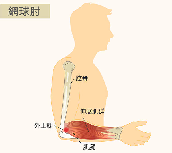 网球肘称为“肱骨外上髁炎”。过度使用伸展腕关节或手腕伸展肌群持续用力，便容易造成肌腱受伤。（Shutterstock/大纪元制图）