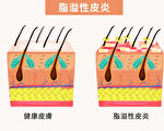 头皮和皮肤发痒脱屑？脂溢性皮炎爱找上3类人