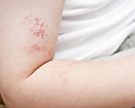 带状疱疹患者出现水泡后，病情越来越严重，往往有万针刺心一般的痛苦。(Shutterstock)