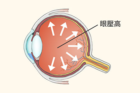 眼压高当心青光眼!医师教你这样做 远离青光眼