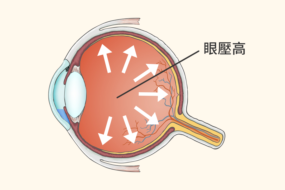 眼壓高當心青光眼 醫師教你這樣做 遠離青光眼 降眼壓 青光眼預防 飲食 大紀元