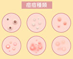 你的痘痘是哪种 严重吗？1篇看懂痘痘种类