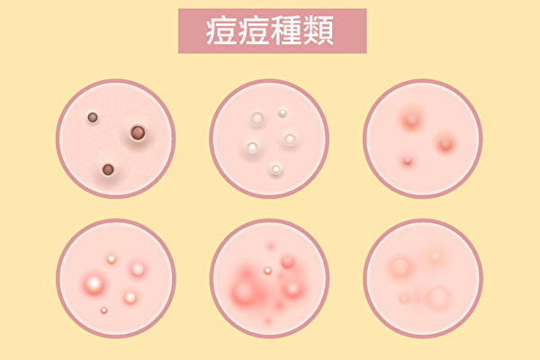 青春痘（痘痘）分不同种类和等级，严重程度和处理方法也不同。（Shutterstock/大纪元制图）