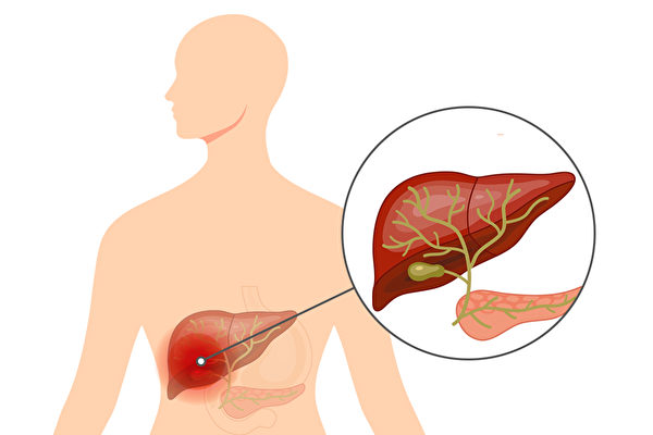 症状 胆管 癌 胆管細胞癌の症状・原因・治療法