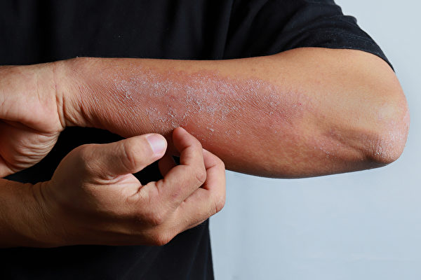 進入秋冬季，很多人皮膚會乾癢，甚至出現濕疹，如何保養和改善？(Shutterstock)