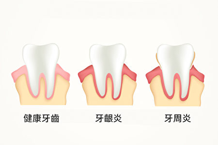 牙周病不仅是口腔疾病，也可能意味着身体已经慢性发炎。(Shutterstock)