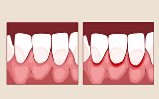 别让牙齿走不归路 牙龈发炎8大原因一定要知道