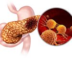 科学家发现最常见胰腺癌成因