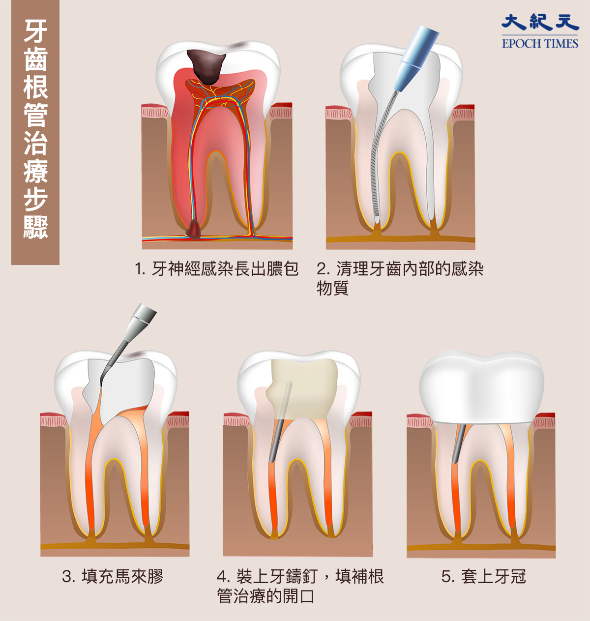 微创小根管 显微大世界——牙体牙髓科特色医疗-口腔医院
