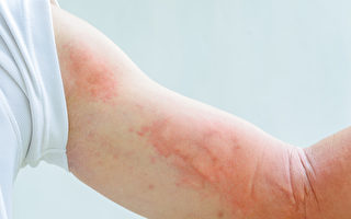 新州北部地區現麻疹病例 衛生部門發警報