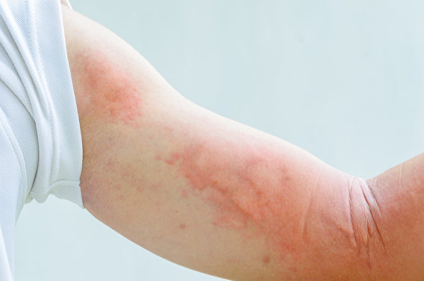 當人體接觸到病菌、粉塵等外來物質時，觸發免疫系統過度防衛，就可能出現過敏性疾病，如蕁麻疹。(Shutterstock)