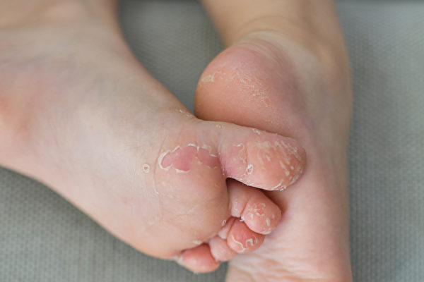 手足口病的常見症狀為輕度發燒（低於38℃）、手、腳以及臀部的皮膚出現小水泡。(Shutterstock)