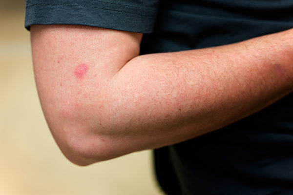 中共肺炎（又称武汉肺炎、COVID-19）出现了许多新症状，如皮肤疹或水泡。示意图。(Shutterstock)