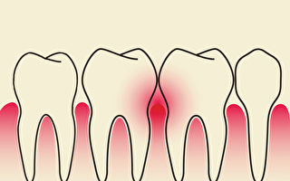 牙齒疾病是從古至今的困擾。中醫如何治療牙周病、保養牙周？(Shutterstock)