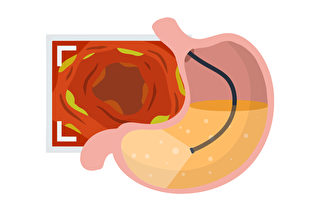 照胃镜会疼痛吗？胃镜检查有何注意事项？(Shutterstock)