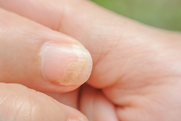手部若感染灰指甲，可能造成身体其他部位也受到感染。(Shutterstock)