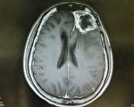 科学家找到要害基因 彻底清除致命脑癌
