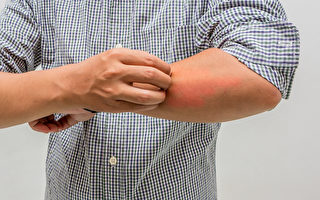疥瘡堪稱「最癢皮膚病」傳染力強 5招預防