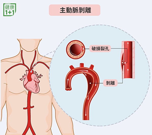 主動脈剝離的形成，是由於血管內膜破損，血液經由內膜的裂孔流入血管壁中。（健康1+1／大紀元）