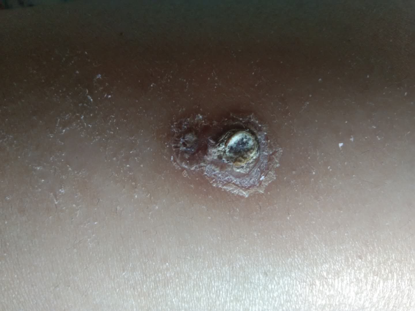 2017年10月,孫鈺翔被官橋鎮政府強制看管期間,疑似遭到警察用菸頭燙傷虐待,家人給他洗澡時發現的傷口。(受訪者提供)