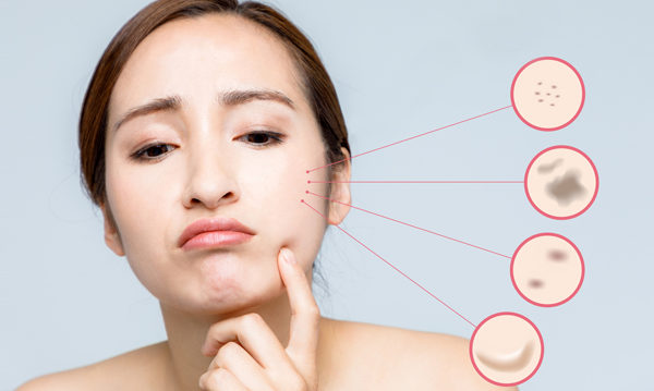 脸上长斑的种类常见有老人斑、雀斑、肝斑和发炎后的色素沉淀。(Shutterstock)