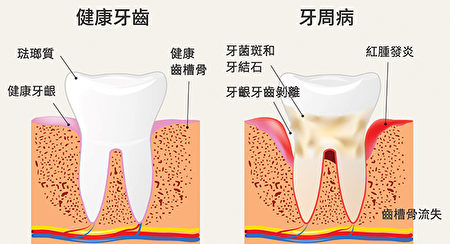 華人好發的口腔疾病──牙周病