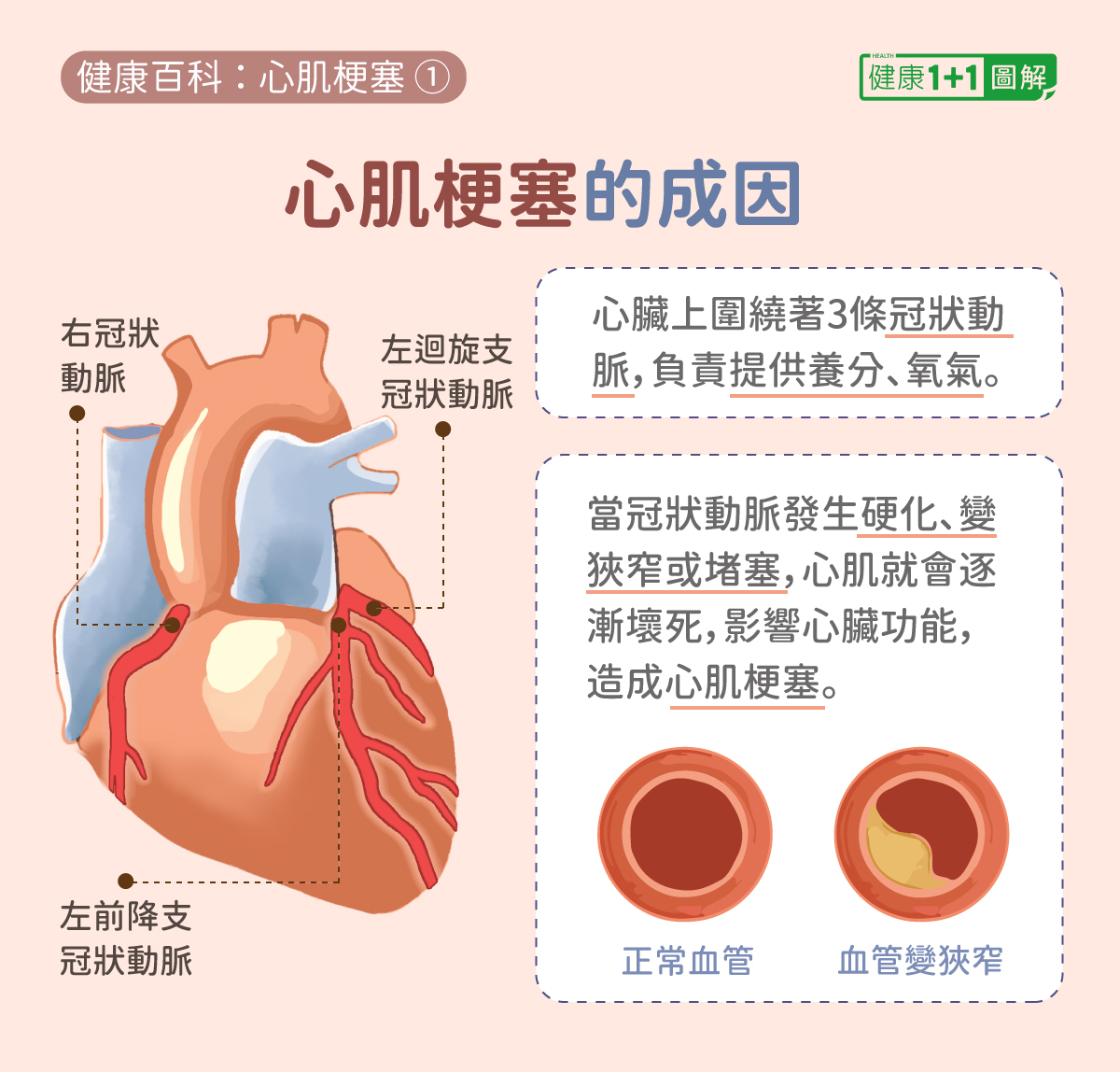 1-15 急性下壁及前间壁、前壁心肌梗死演变过程-心血管-医学