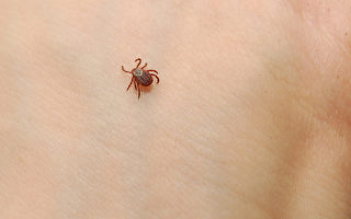 女子多次過敏險致命 竟是因爲曾被蜱蟲叮咬