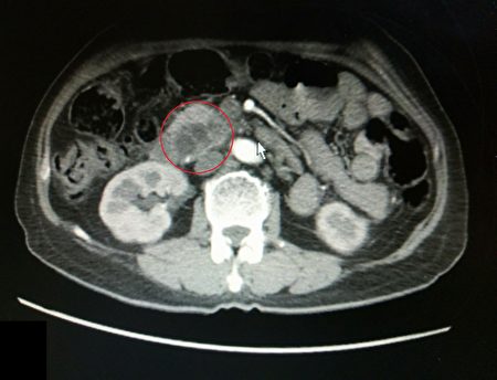 劉女士膽管和胰管都阻塞，且胰臟頭有腫瘤（紅圈處），切片確診為胰臟癌。