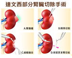 车祸意外发现肾癌 部分切除重获健康