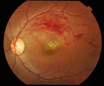 年逾50有三高病史者视力糢糊恐眼中风上身 视网膜 高血压 大纪元