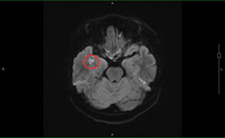 沉积在脑部右边颞叶的脂肪粒（红圈处），导致少年出现情绪症状。