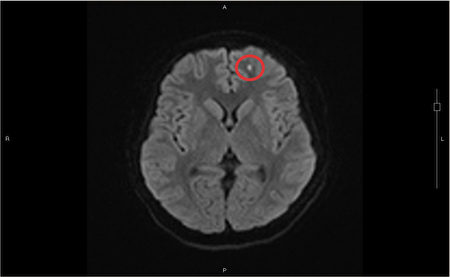 沉积在脑部左边额叶脂肪粒（红圈处），导致少年出现情绪症状。