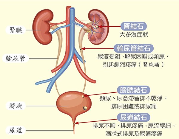 身體常見的腎結石、尿道結石等結石疾病的症狀。（原水文化提供）