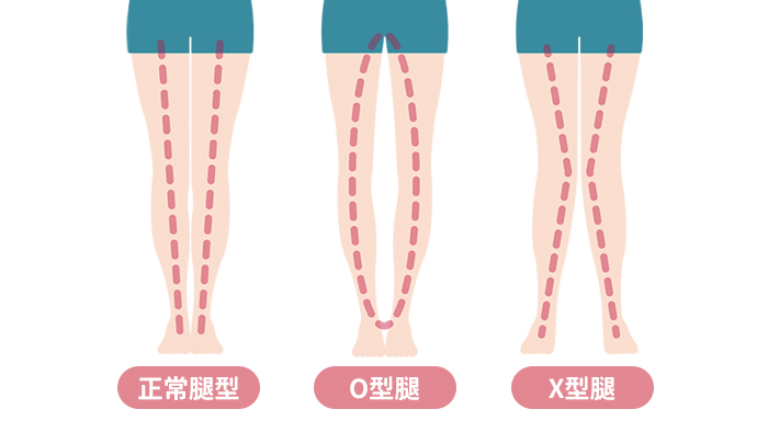 孩子o型或x型腿怎么办 一些症状当心是疾病 O型腿 罗圈腿 腿型 大纪元