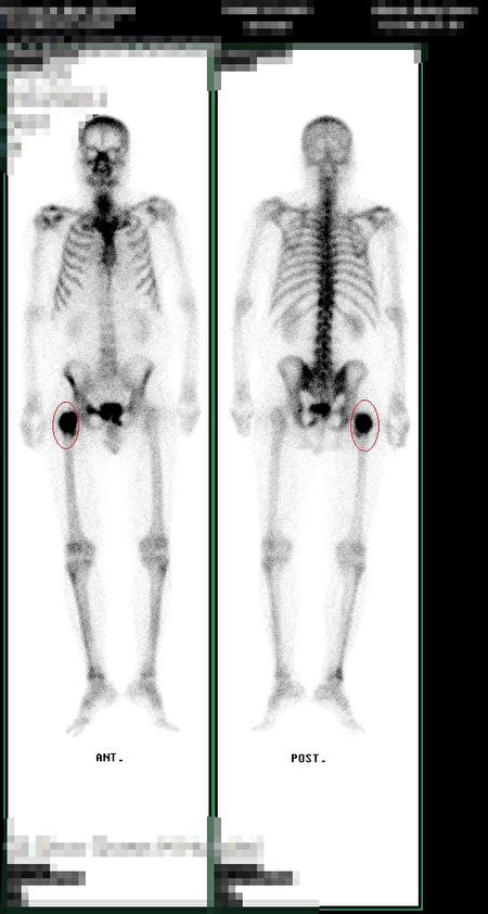 上圖為張先生的核子骨骼掃描照，紅圈處為癌細胞轉移到大腿骨。