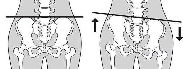 骨盆倾斜会让腰方肌等背部肌肉承受额外的负担，引发激痛点。(Shutterstock)