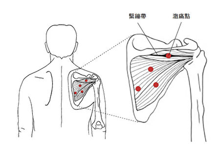激痛點一按就痛!揪出2大原因 疼痛不再來