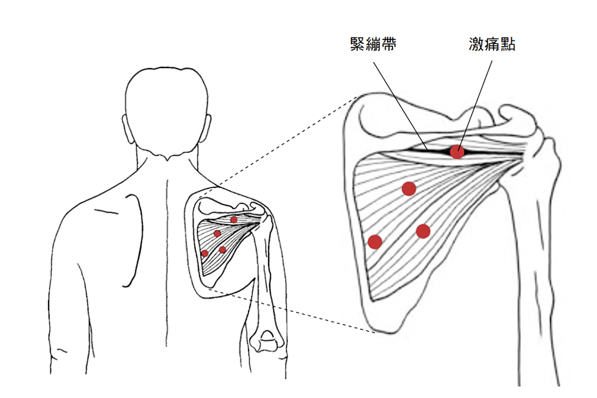 激痛点一按就痛 揪出2大原因疼痛不再来 症状 姿势 肌肉 大纪元