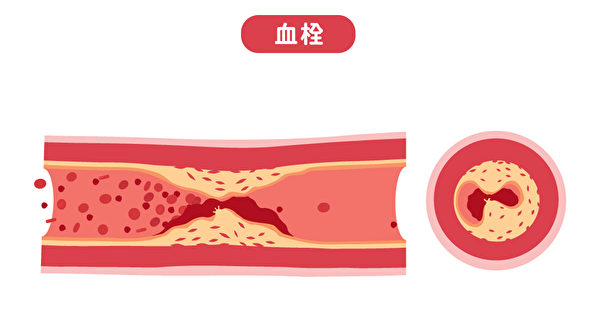 示意图：动脉中的血栓堵住血管，会影响了血液的流通。(Shutterstock)